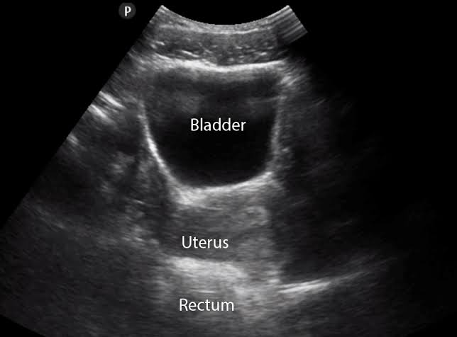 Retrograde intrarenal surgery RIRS